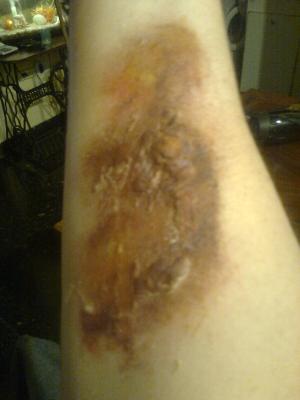 HERIDA EN EL ANTEBRAZO